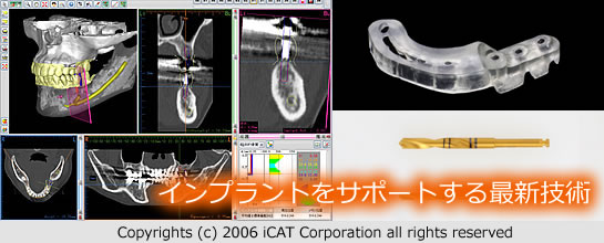 インプラントをサポートする最新技術