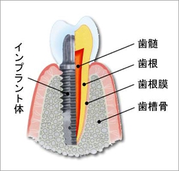 自家歯牙移植