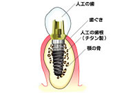 インプラント構造