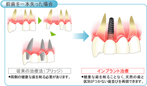 前歯を一本失った場合