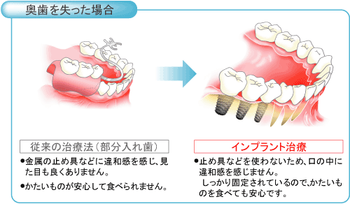 奥歯を失った場合