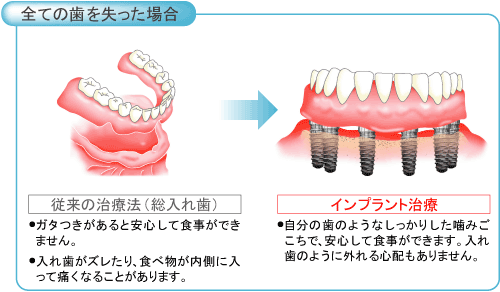 全ての歯を失った場合