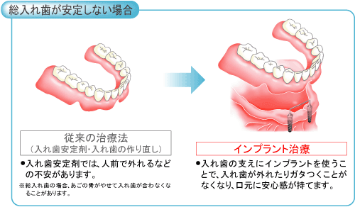 総入歯が安定しない場合