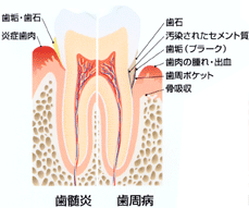 歯周病